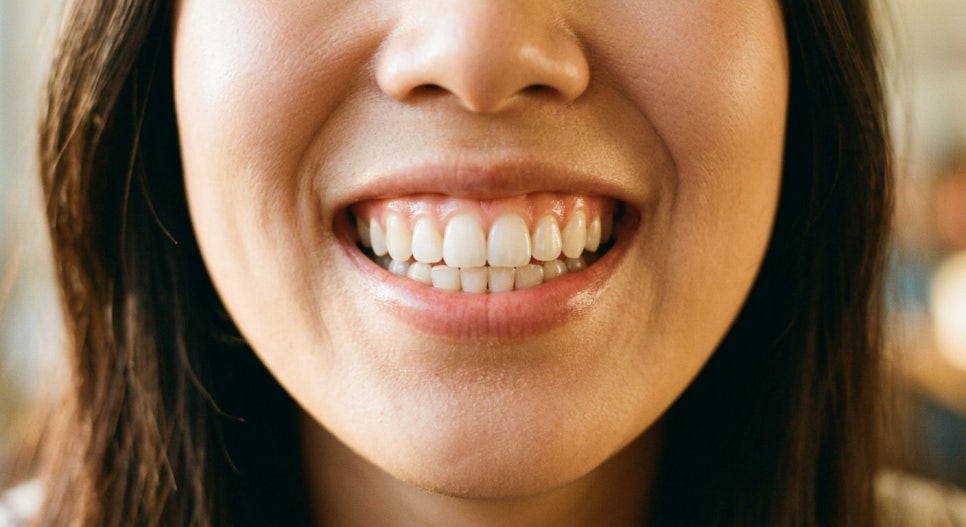 Daechi-dong Dental Clinic Prices/Costs: 3 Things to Know Before Bracket Orthodontic Treatment image 9