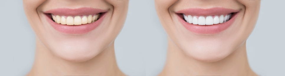 3 Differences Between Laminates and All-Ceramic: Be Sure to Know Before Aesthetic Treatment! image 1