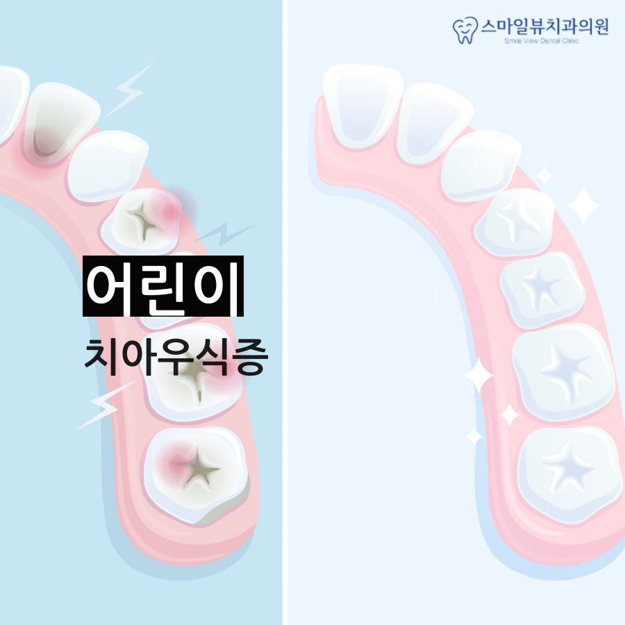 강남소아치과 정기적으로 검사해요! 관련 이미지 3