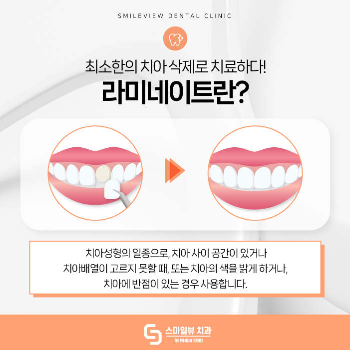 논현역치과 라미네이트 신중히 선택해야 하는 이유는? 관련 이미지 2