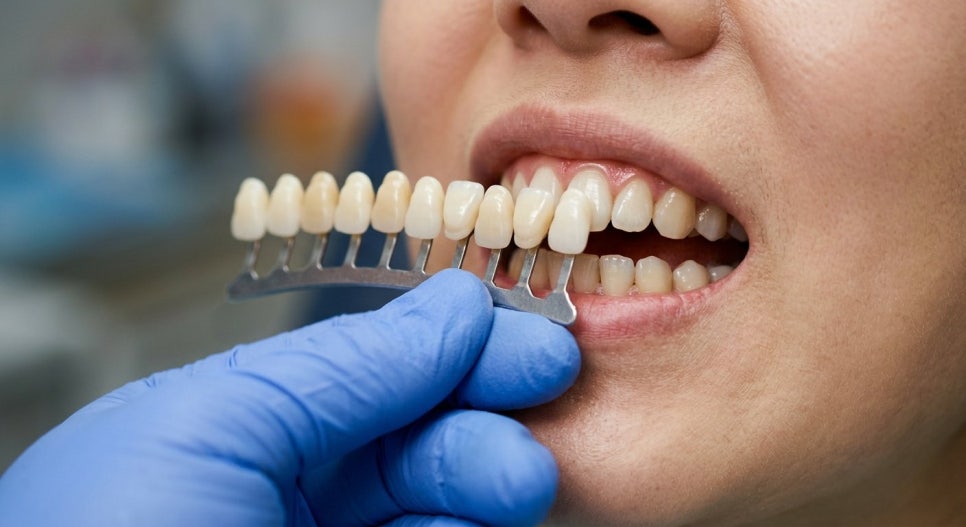 Teeth Whitening Event Amount/Price/Cost? Reviews, the 2 Things More Important Than Finding a Cheap Place image 3