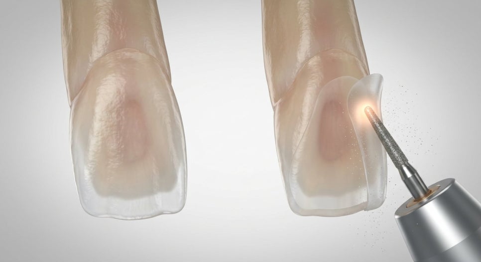 Bunny Teeth Laminate Veneers: Temporary Teeth Before and After—Are Two Front Teeth Enough? (Read This Before Worrying About Price/Cost) image 4