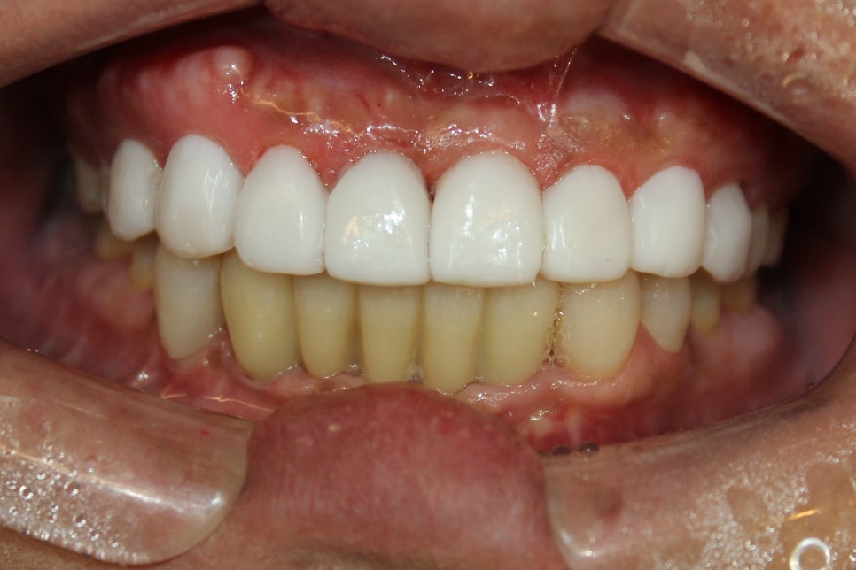 Introducing Resin Veneers for Front Tooth Treatment in Front of Sinnonhyeon Station image 2