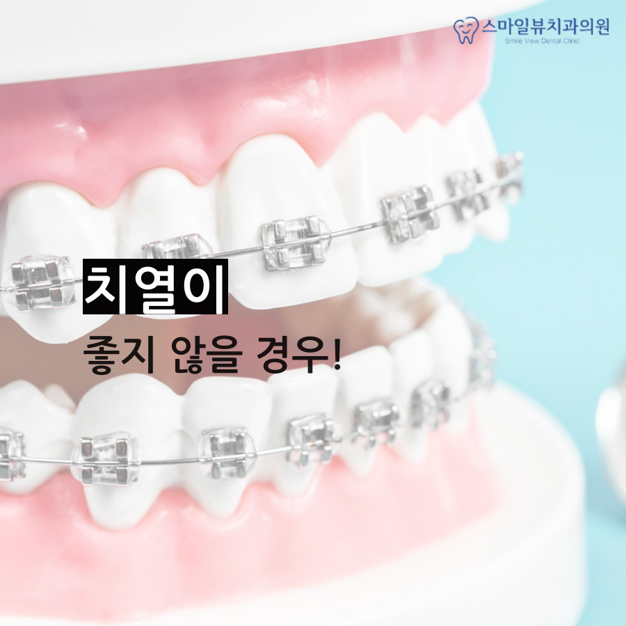강남덧니교정 치아를 바로 잡아요! 관련 이미지 2