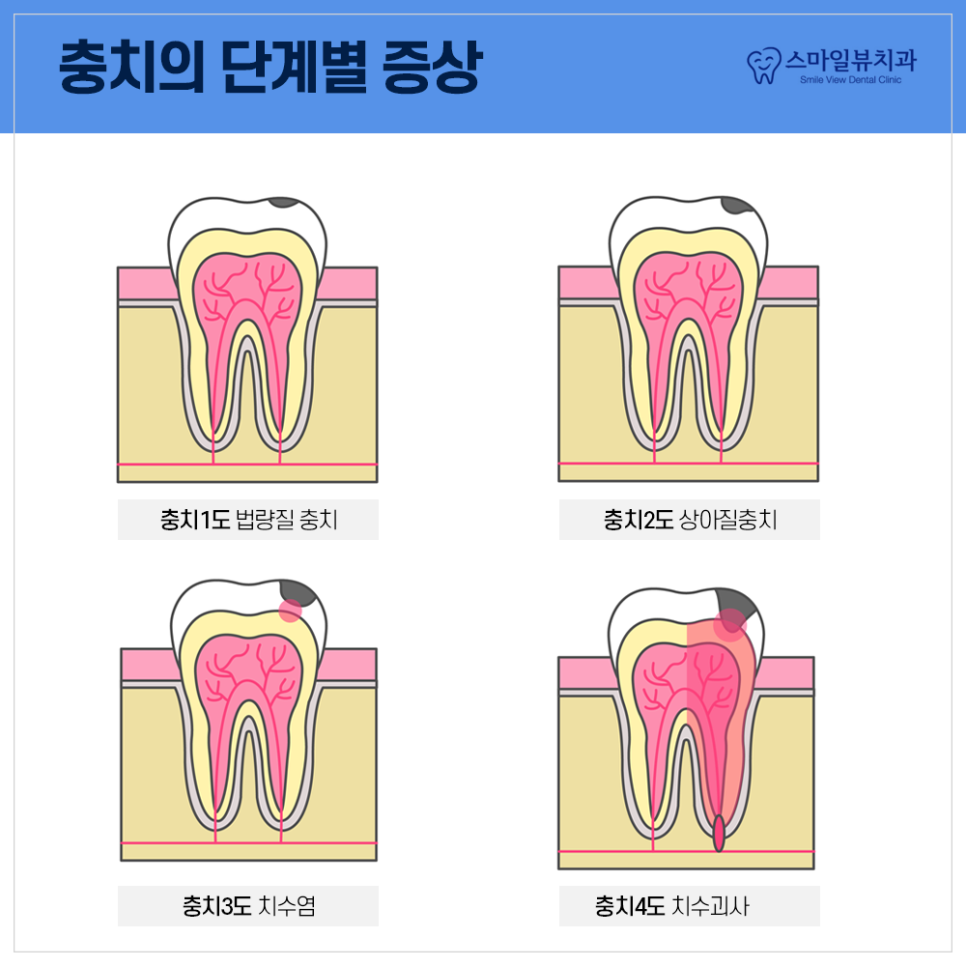 논현동 치과 신경치료 시 알아두면 좋은 것들 관련 이미지 2