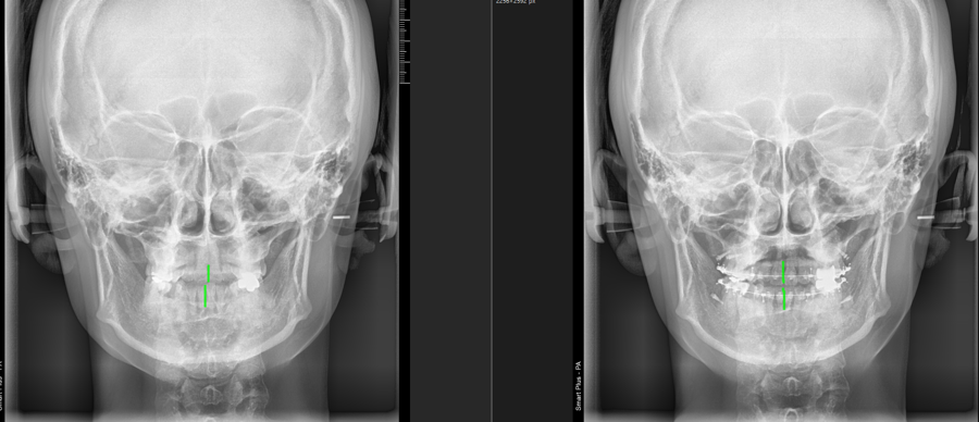 A Case Corrected Without Asymmetry Surgery image 2