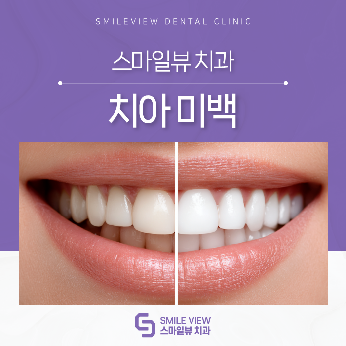 Seoul Teeth Whitening: Why does a bright impression get overshadowed, and why do teeth gradually turn yellow? image 1
