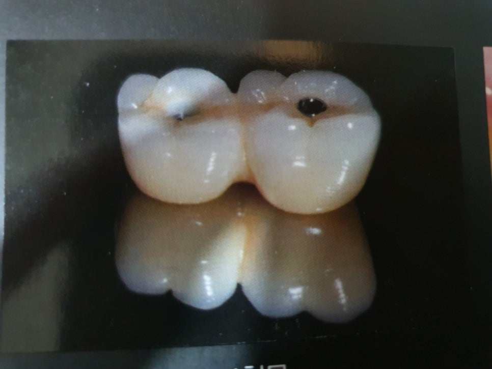 신논현역치과 임플란트 잘하는 치과 관련 이미지 8