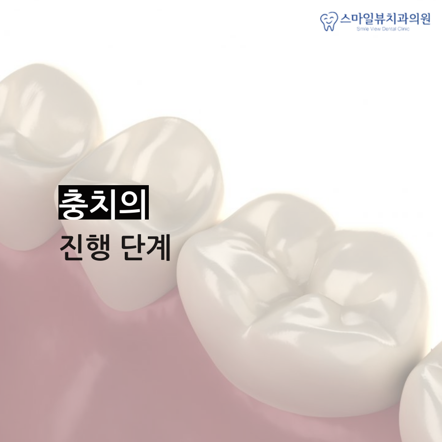 강남치과레진인레이 두 재료의 다른 점은? 관련 이미지 2