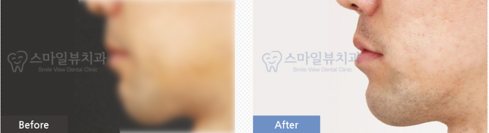 신논현역치과 역교정 관련 이미지 3