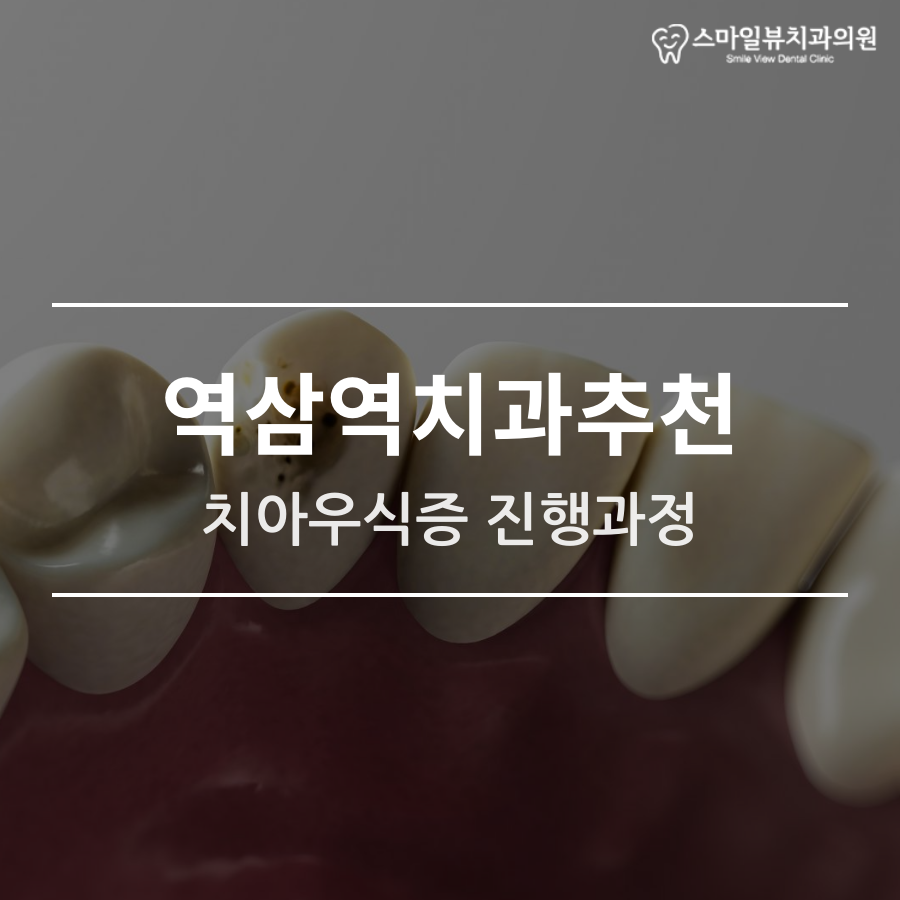 역삼역치과추천 치아우식증 진행과정 관련 이미지 1