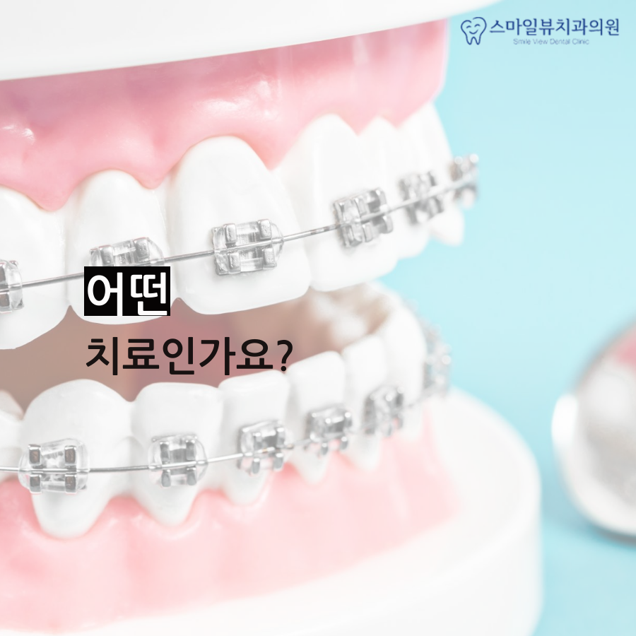 역삼역앞니교정 틀어지고 벌어졌다면? 관련 이미지 2