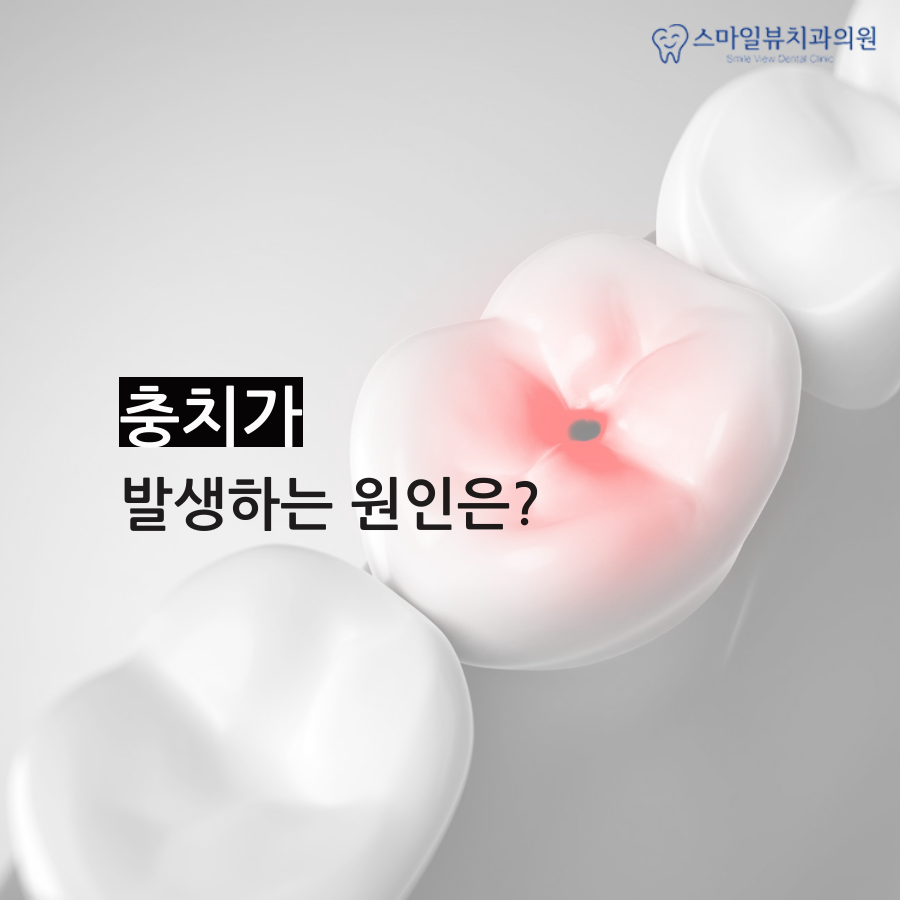 역삼동깨진치아 방치할 경우 문제점 관련 이미지 3