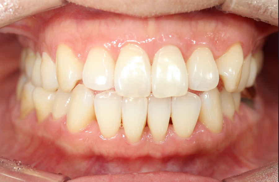 A Case Corrected Without Asymmetry Surgery image 1