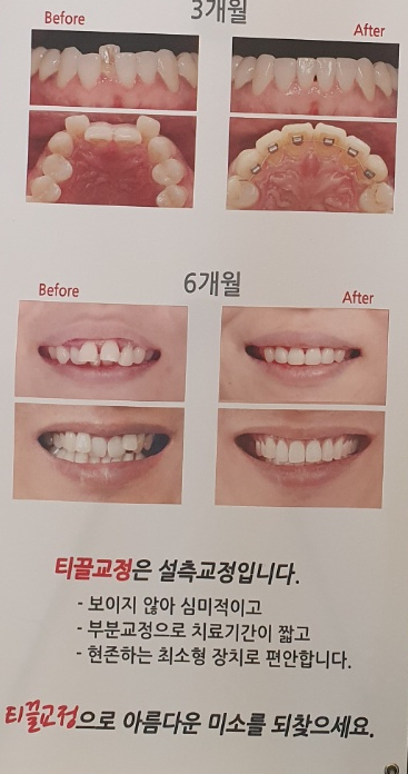중년 돌출입, 앞니만 살짝 교정하세요!!! 관련 이미지 10