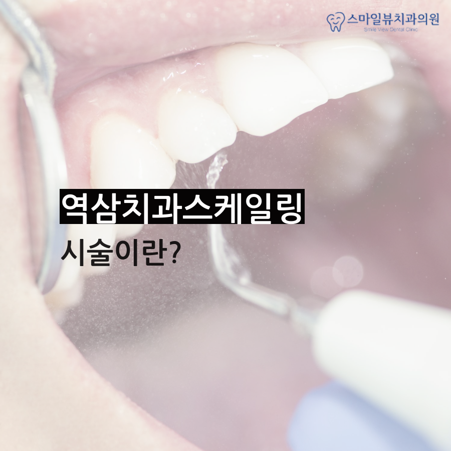 역삼치과스케일링 충치와 잇몸질환 예방법 관련 이미지 4