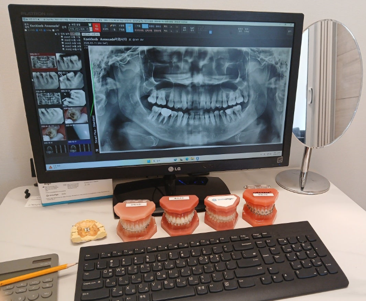Looking for a Recommended Gangnam Orthodontic Clinic? Check This Before Starting Treatment for Protruding Front Teeth and a Protruding Mouth image 2
