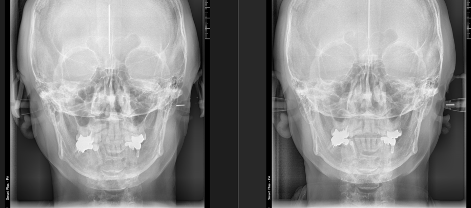 A Case Where Asymmetry and the Temporomandibular Joint Improved After Orthodontic Treatment image 1