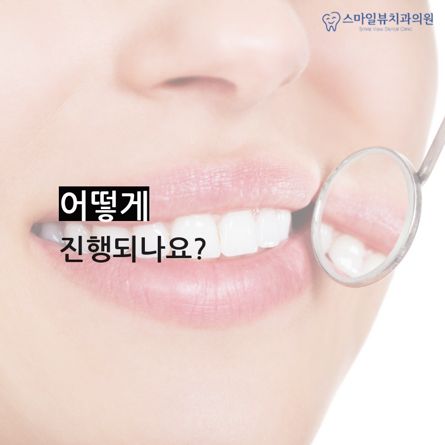 강남역비발치교정 신중한 선택이 필요 관련 이미지 4