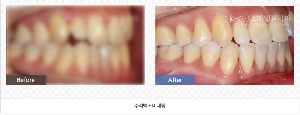 신논현역 치과 비수술 양악교정 관련 이미지 8