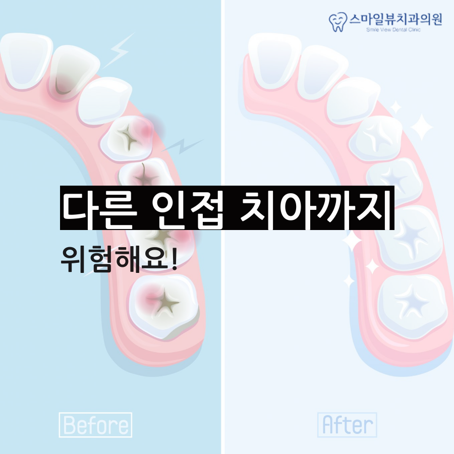 신논현앞니충치 치아 상태를 확인해요! 관련 이미지 3