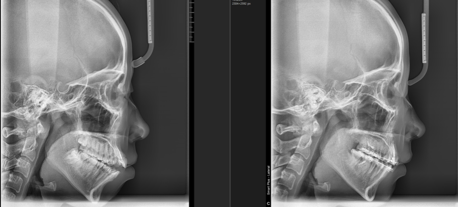 Non-Surgical Orthodontic Correction for Open Bite image 2