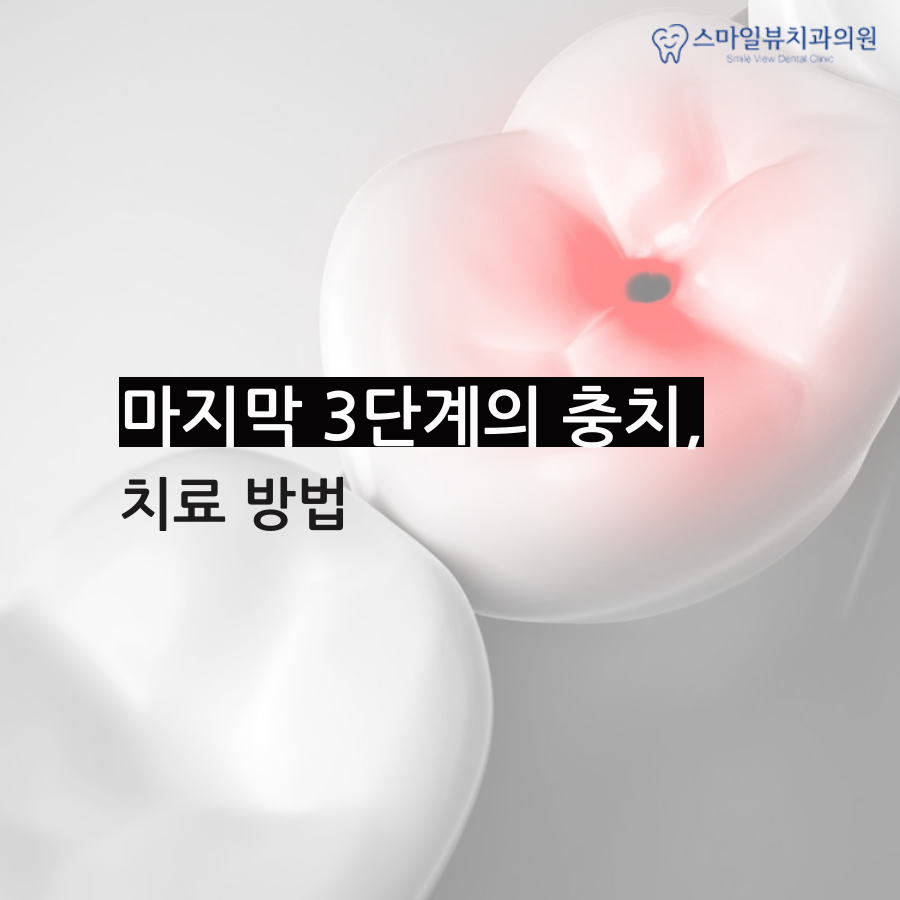 역삼치과치아진료 치수염의 위험성 관련 이미지 3