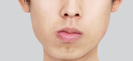 신논현역 치과 비수술 양악교정 관련 이미지 5