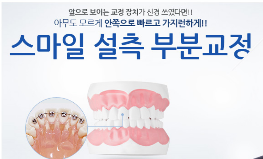 신논현역 치과 설측 부분교정 관련 이미지 5