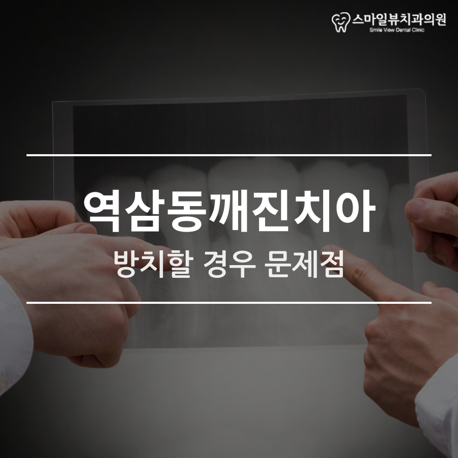역삼동깨진치아 방치할 경우 문제점 관련 이미지 1
