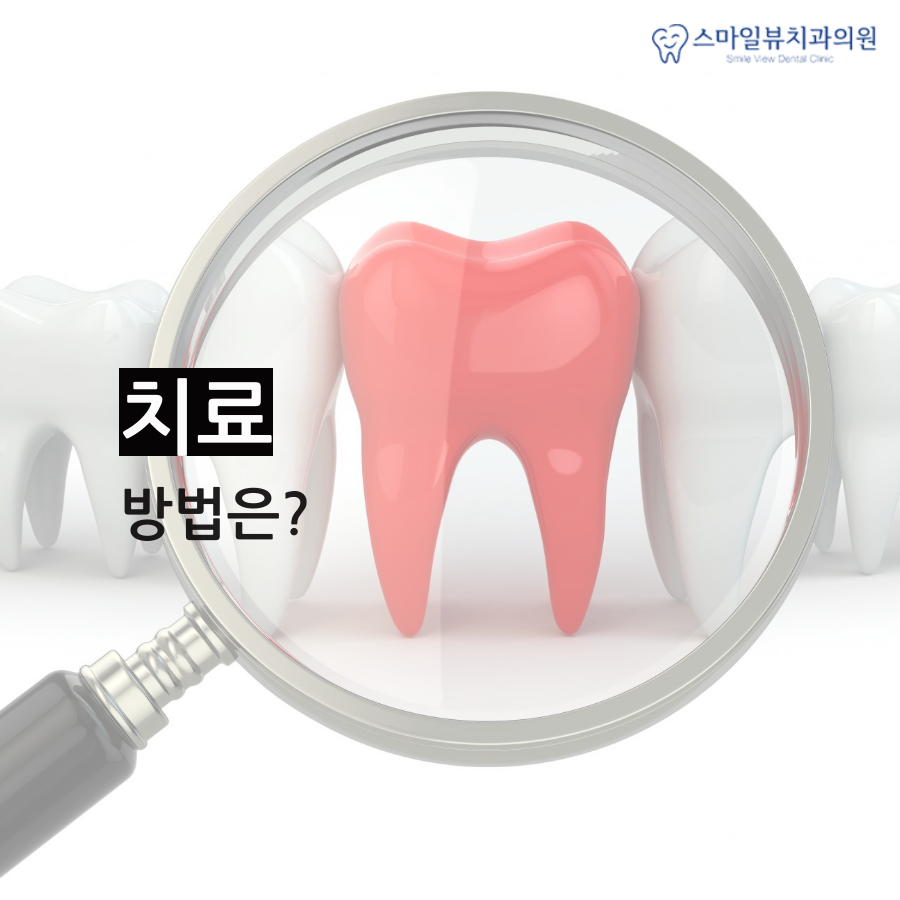 강남치과앞니충치 영구치를 보호해요! 관련 이미지 4