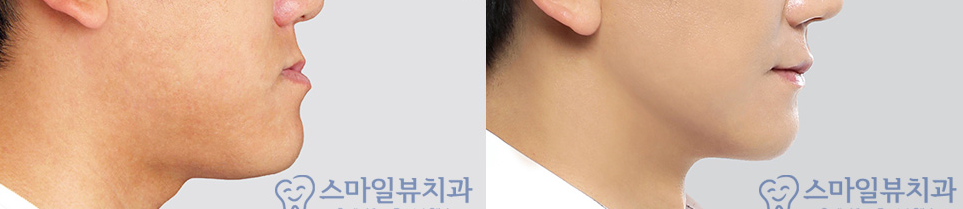 교정할 때 치아관리방법 관련 이미지 3