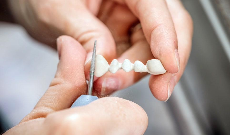 3 Differences Between Laminates and All-Ceramic: Be Sure to Know Before Aesthetic Treatment! image 4