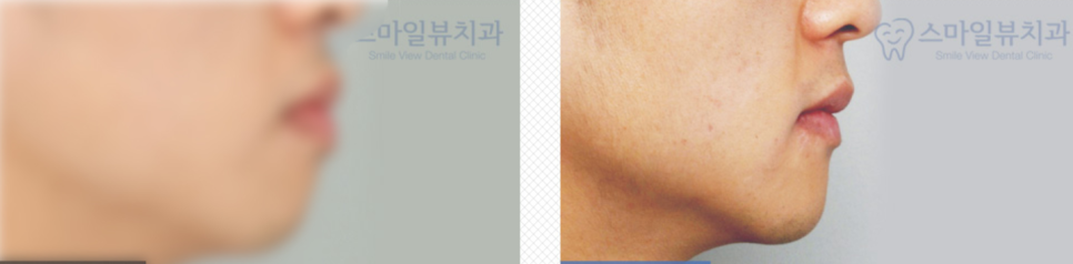 중년 돌출입, 앞니만 살짝 교정하세요!!! 관련 이미지 4