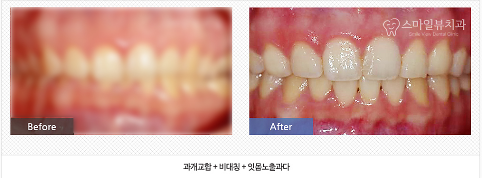 신논현역 치과 비수술 양악교정 관련 이미지 9