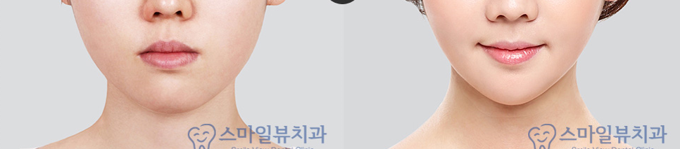 교정할 때 치아관리방법 관련 이미지 2