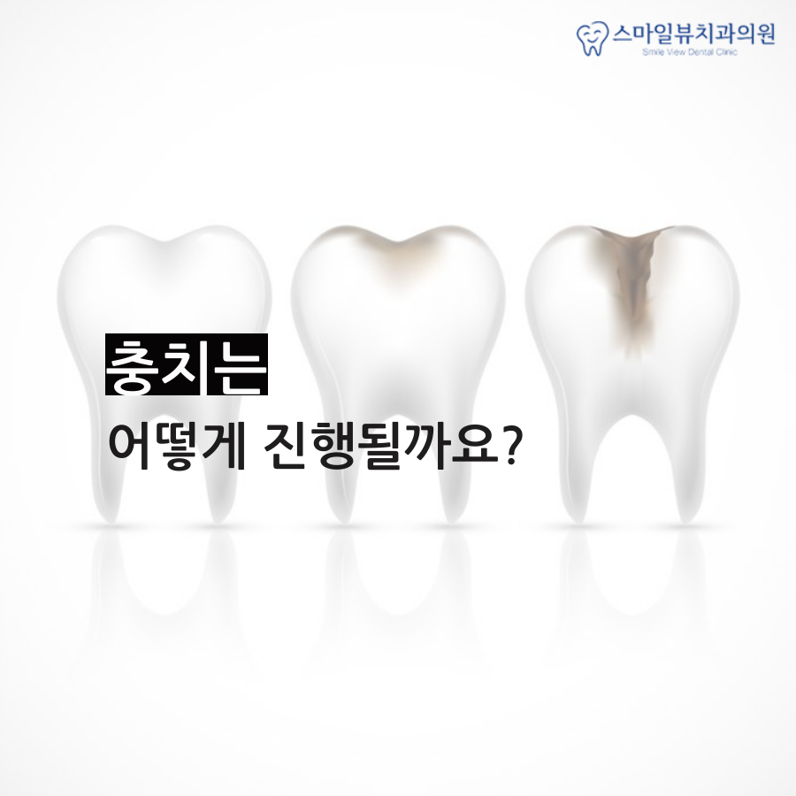 강남치과지르코니아 충치를 예방해요 관련 이미지 2