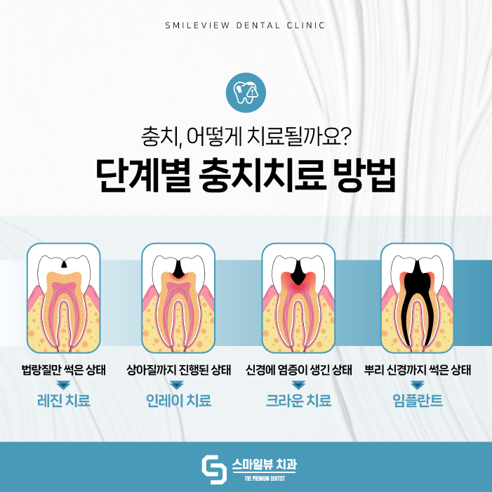 반포동치과 충치 방치하면 후회합니다. 관련 이미지 4