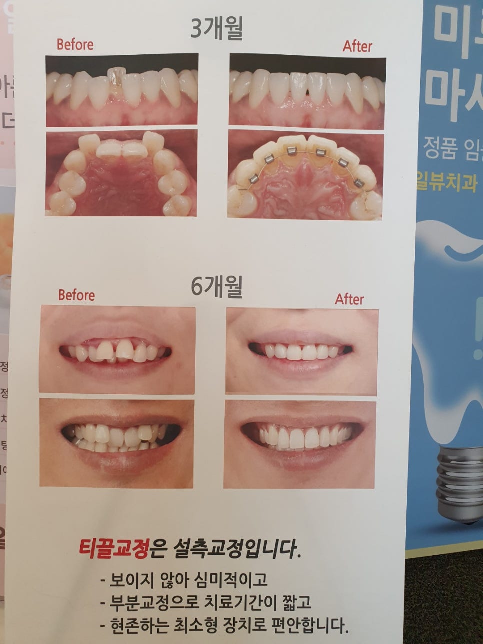 신논현역 치과 앞니 부분 티끌교정 관련 이미지 3