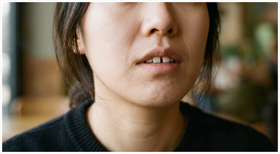 한티역 치과 앞니 벌어짐 원인/증상 해결? 치료 전 관련 이미지 3