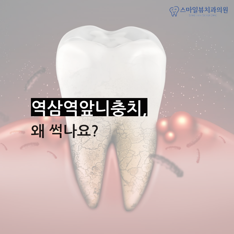 역삼역앞니충치 늦기 전에 빨리 관련 이미지 2