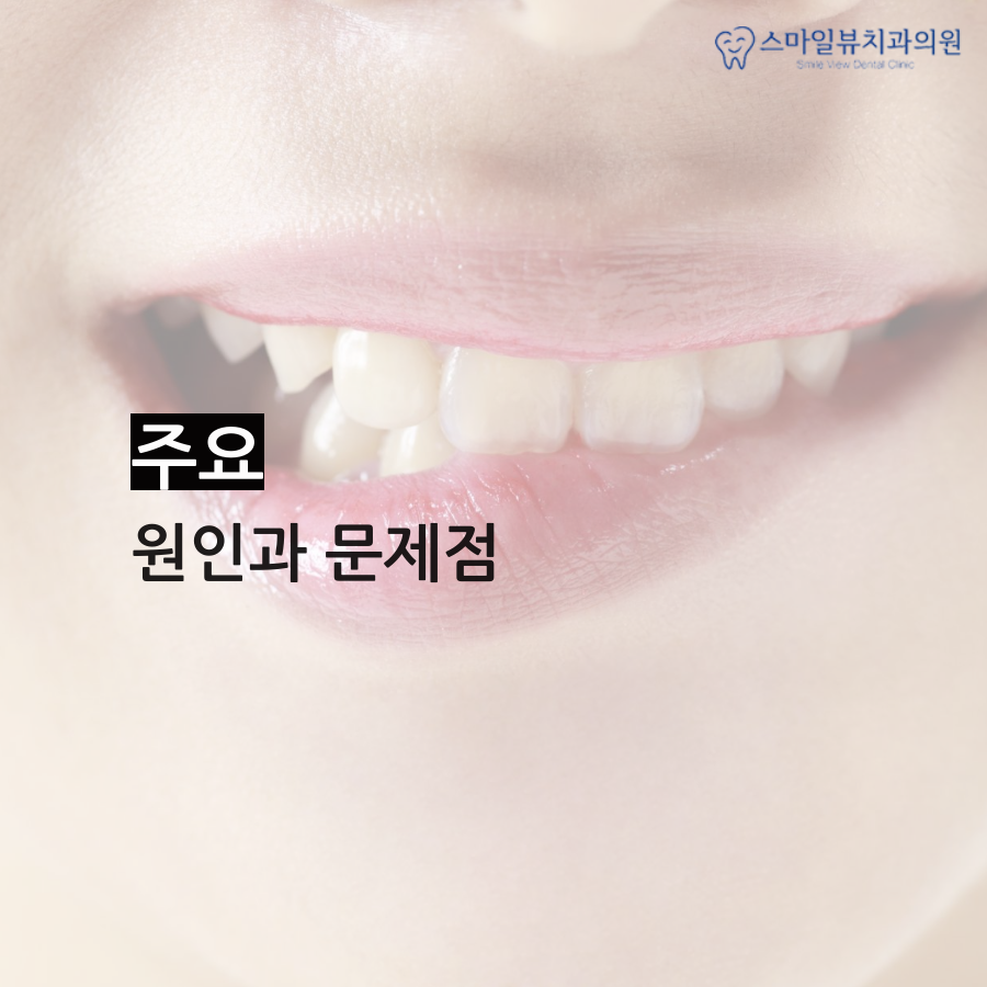 역삼동교정치과추천 심한 주걱턱 관련 이미지 3