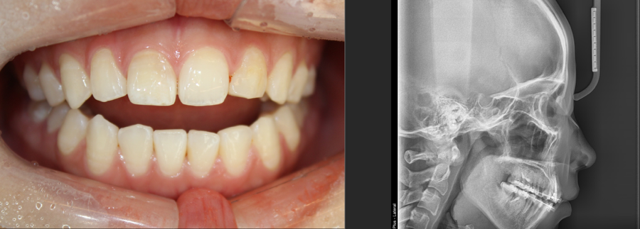 Non-Surgical Orthodontic Correction for Open Bite image 1