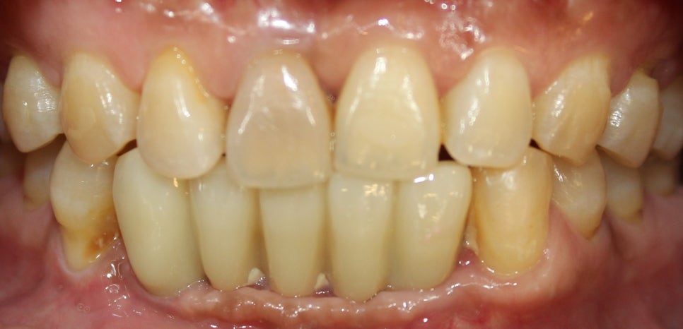Introducing Resin Veneers for Front Tooth Treatment in Front of Sinnonhyeon Station image 3