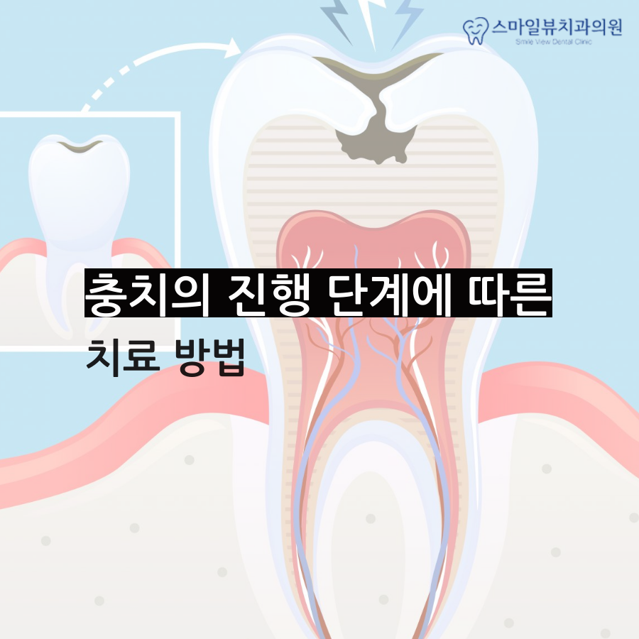 강남소아치과 정기적으로 검사해요! 관련 이미지 4