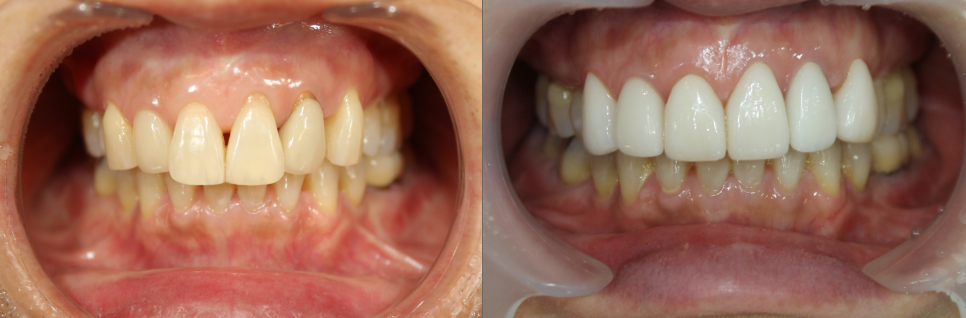 Midlife Veneers: Can They Change You Without Going Too Far? image 1