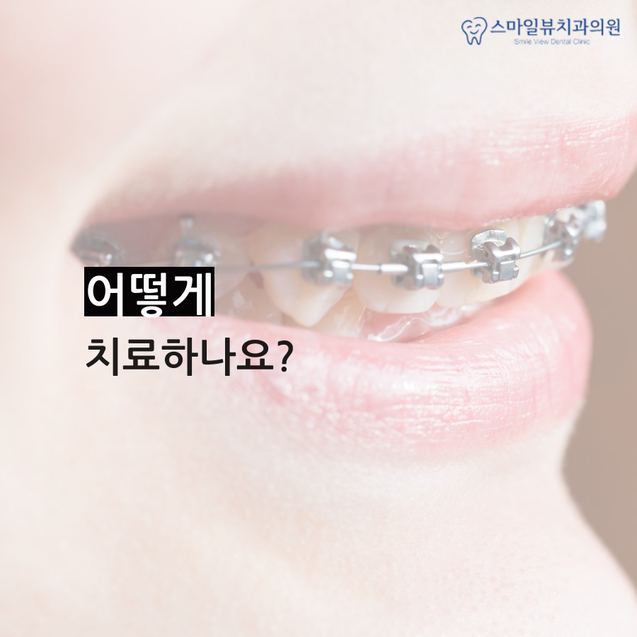 신논현역치과주걱턱 치아교정 치료 관련 이미지 3