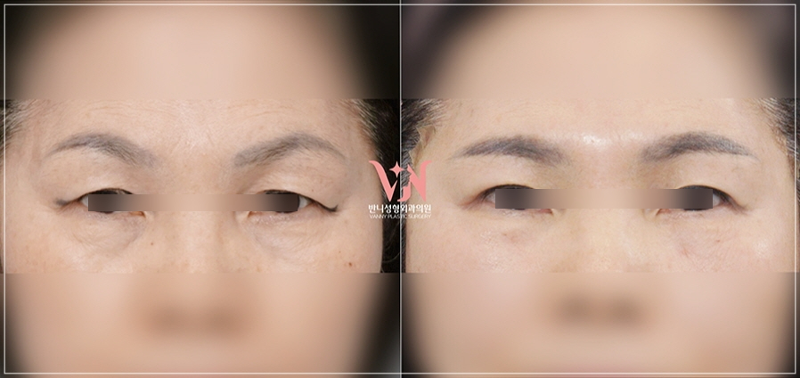A Case Where Upper Blepharoplasty in Gangnam Won’t Help, a Plastic Surgeon’s Honest Opinion image 4