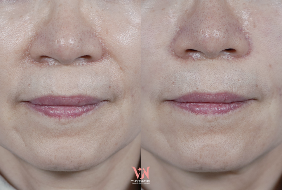 If your face is like this, "buccal fat removal" is not the first step — Gangnam "buccal fat lifting" is. image 25
