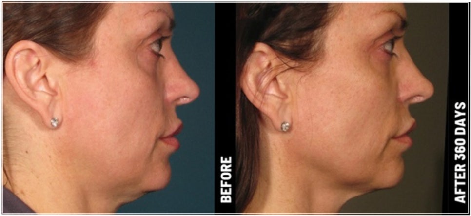 Ultherapy Effectiveness: Fact Check for Thin Faces O, Filling Sunken Areas X (+ Gangnam Event Dermatology Clinic) image 11